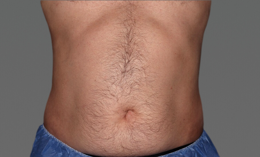 Abdomen_Before_FRONT_Amy Forman Taub MD