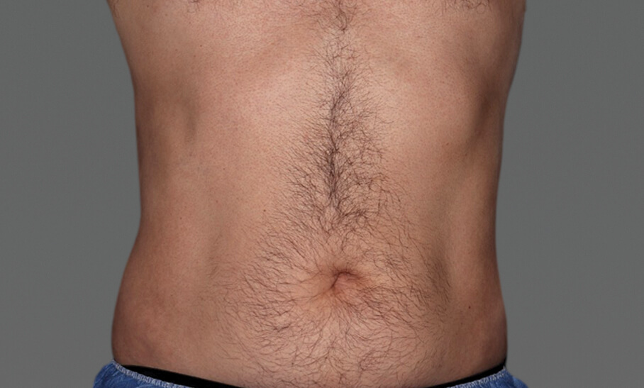 Abdomen_Immediately_After_FRONT_Amy Forman Taub MD