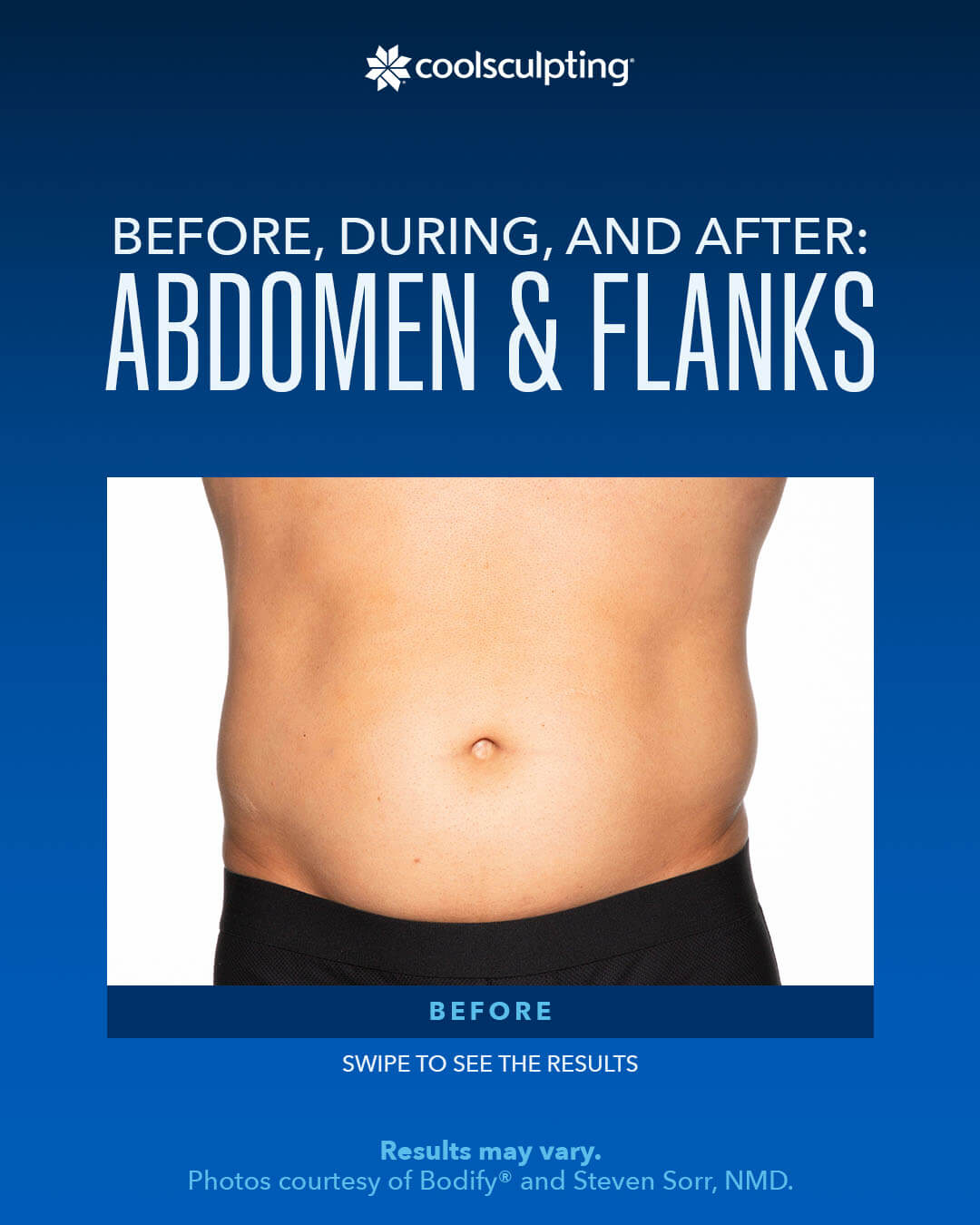 coolsculpting ,Before, During,AND After ABDOMEN &FLANKS