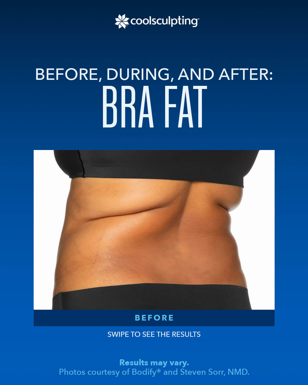 coolsculpting ,Before, During,AND After BRA FAT