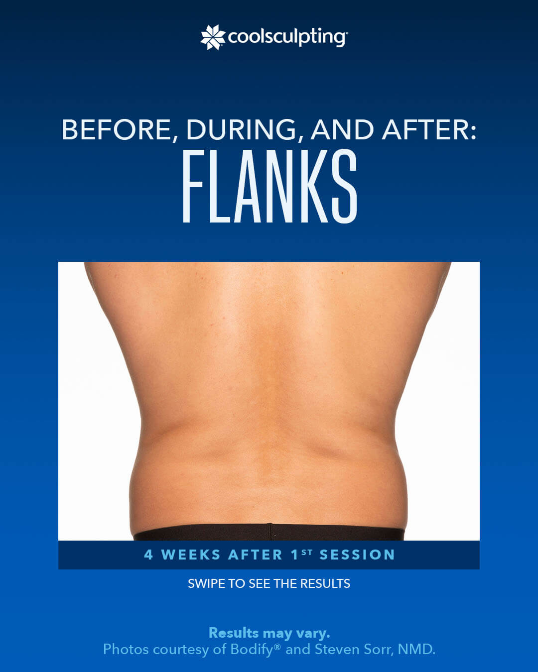 coolsculpting ,Before, During,AND After FLANKS