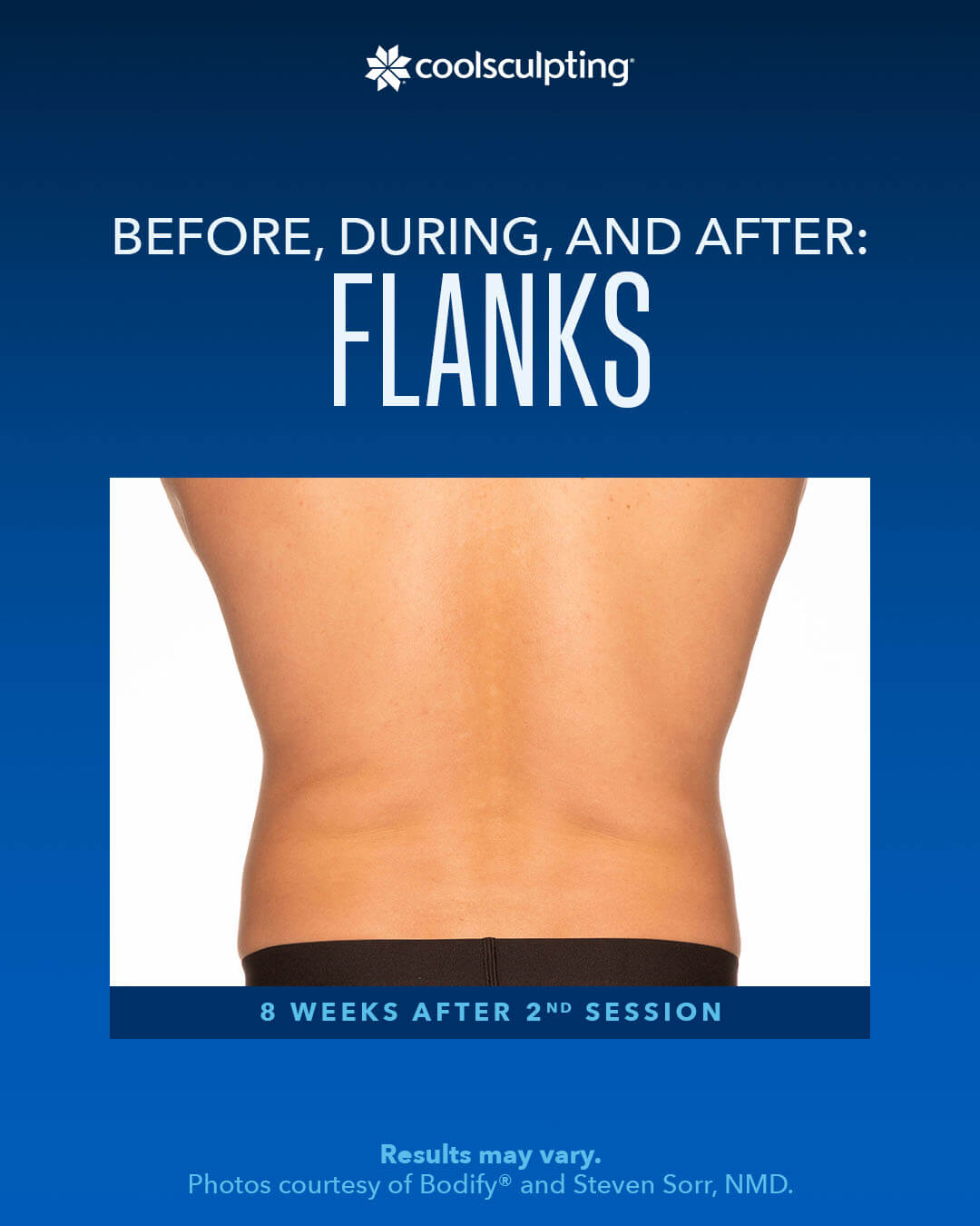 coolsculpting ,Before, During,AND After FLANKS