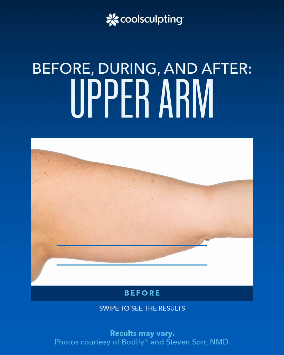 coolsculpting ,Before, During, AND After Upper Arm