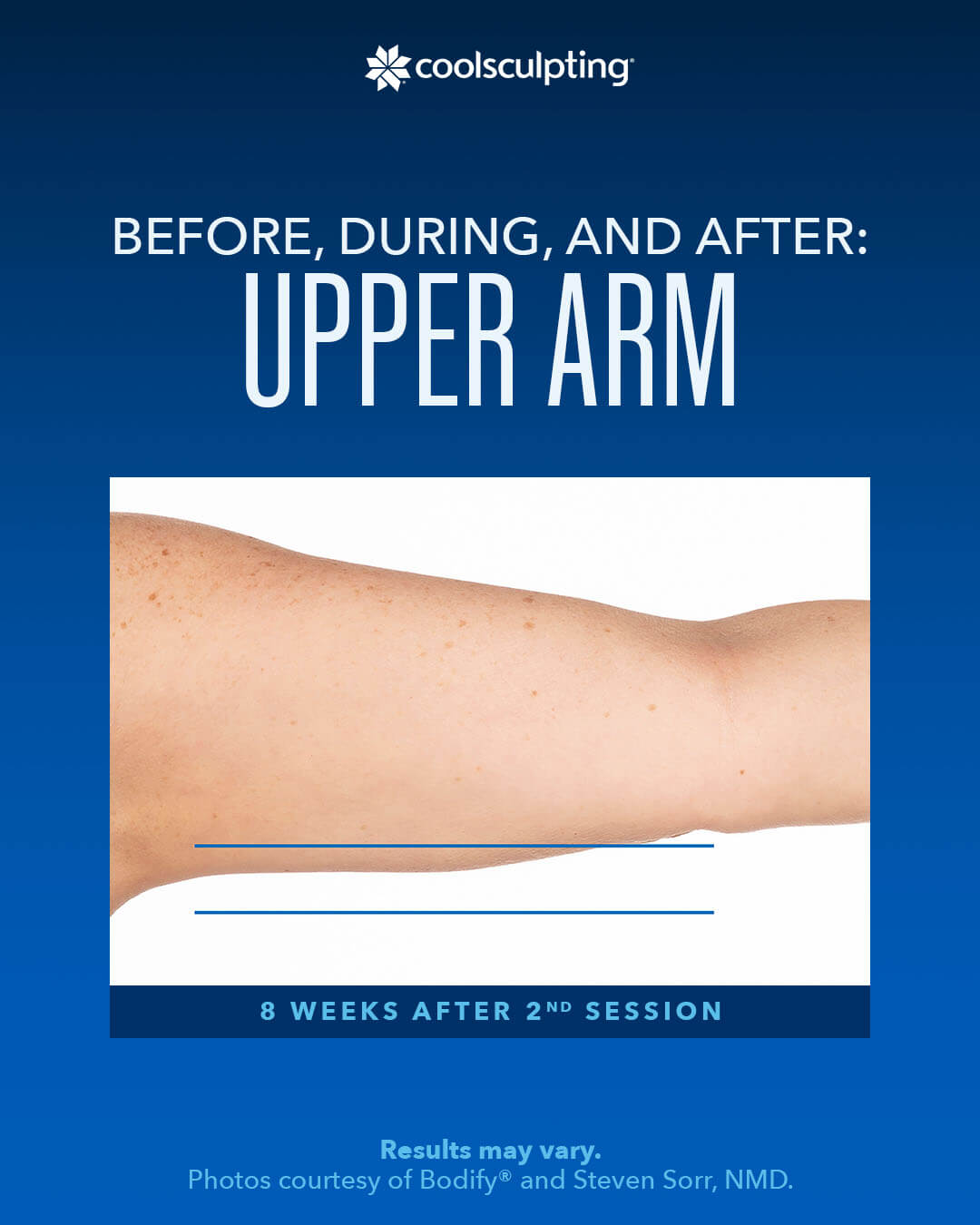 coolsculpting ,Before, During, AND After Upper Arm