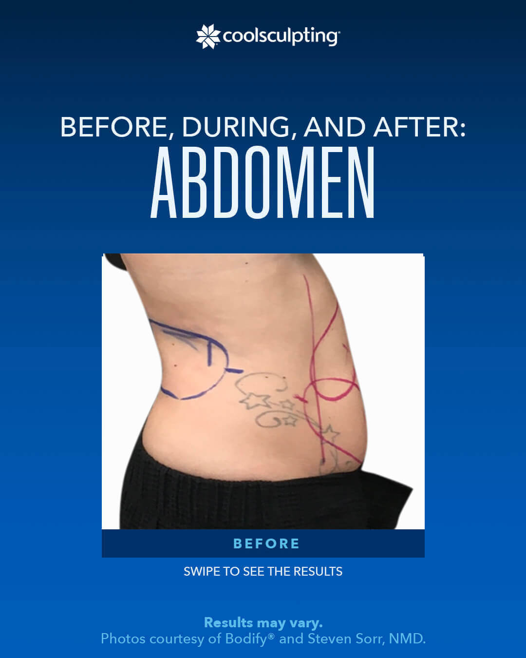 Before, During,and After ABDomen
